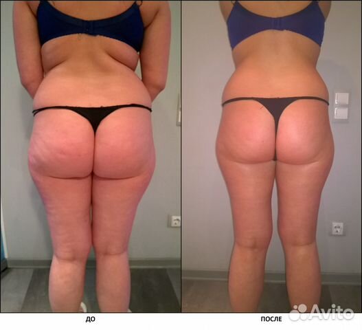 Антицеллюлит. вакуумный массаж тела,лица,кавитация