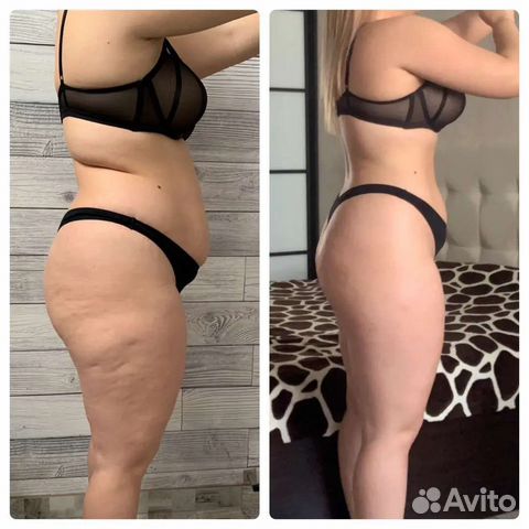 Lpg массаж, уз кавитация, РФ лифтинг и т. д